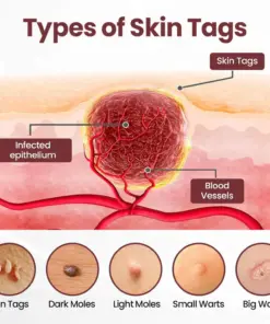 Unpree® KeraErase Dual-Action Renewal Cream